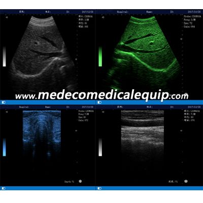 Full-Digital Laptop Ultrasound Scanner ME-580