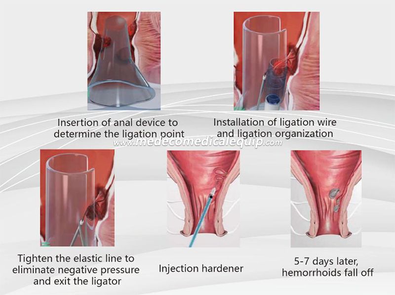 Medical Surgical Disposable Anorectal Ligator Stapler with CE