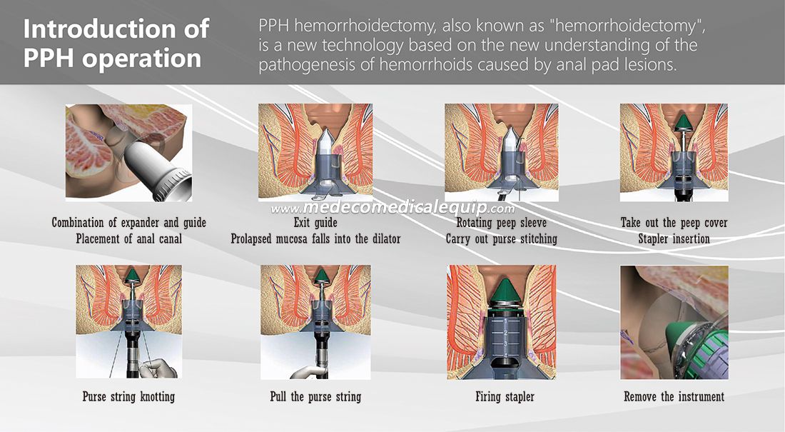 Disposable Anorectal Surgical Staplers and Accessories for Anorectal Operation with CE