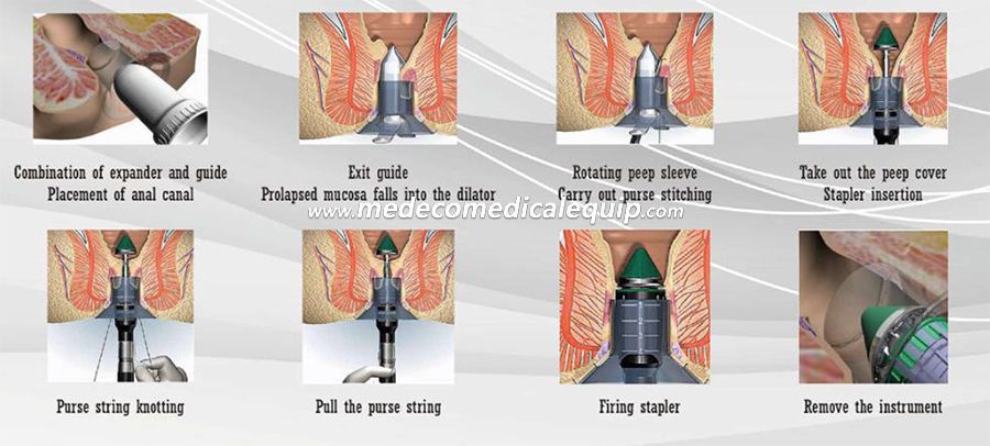 Operation Equipment Disposable Anorectal Staplers for Hemorrhoid Diease