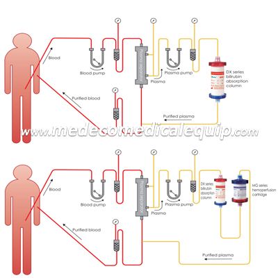 Hospital Disposable High Flux Polyethersulfone Sterilisation Hemodialyser for Hematodialysis